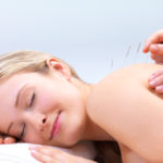 Acupuncture needles on the back of a beautiful woman